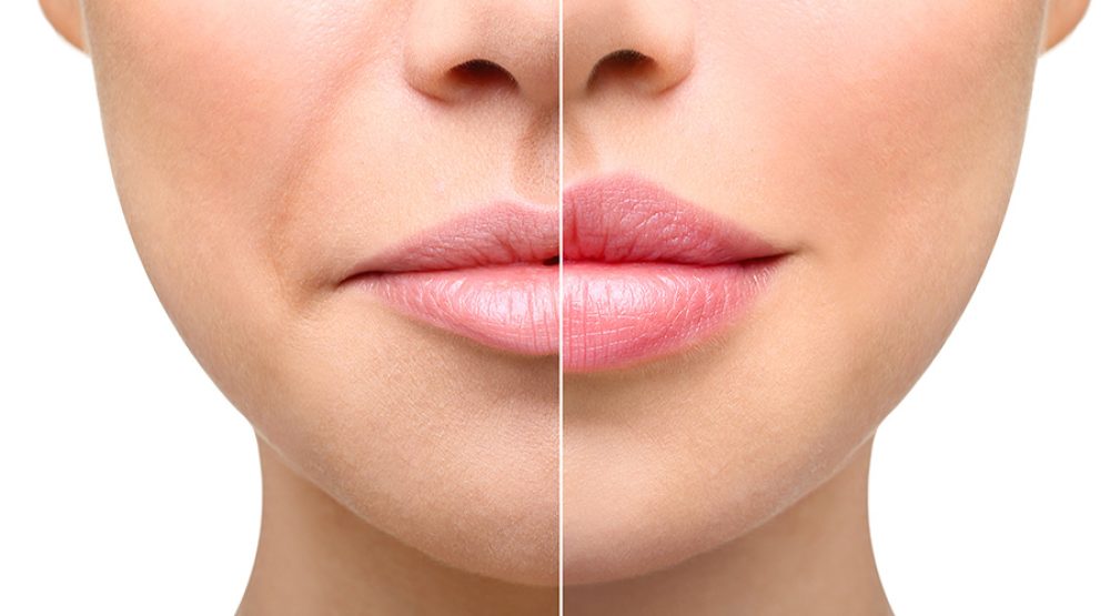 Vorher-nachher-Vergleich des Gesichts einer Frau, der die Wirkung von Dermal Fillern zeigt, mit reduzierten Falten und verbessertem Lippenvolumen.